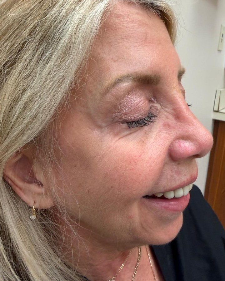 Dermal Fillers — after