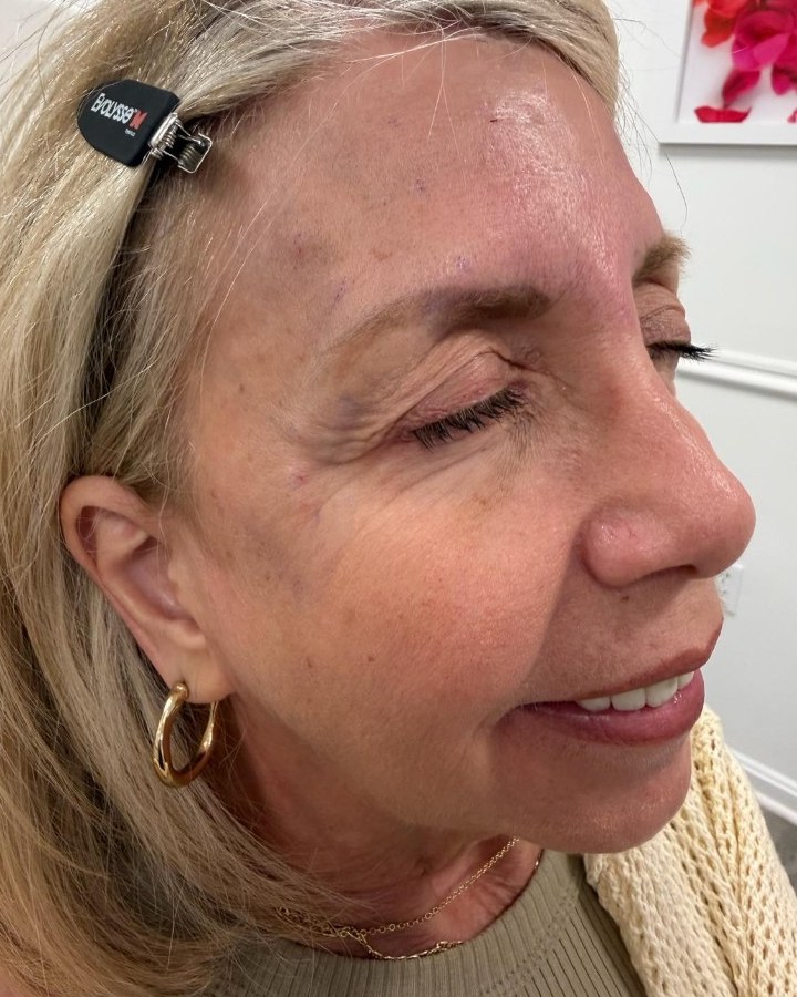 Dermal Fillers — before