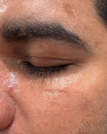 Microneedling — after
