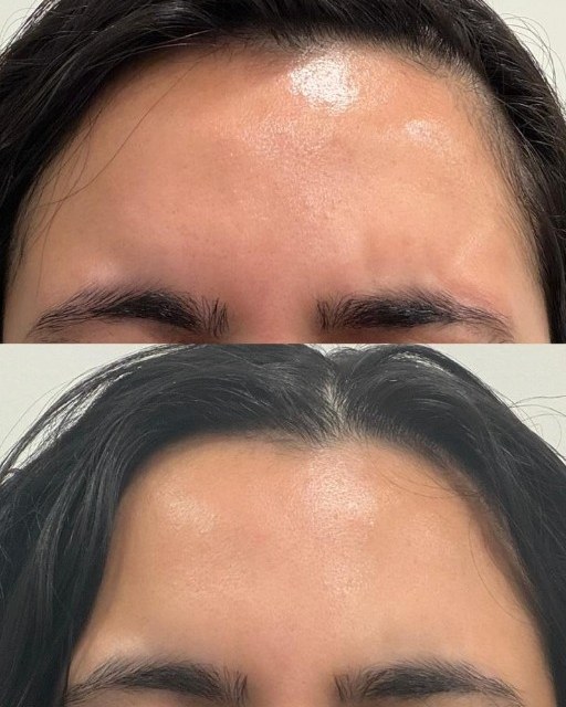 Wrinkle Relaxers — after